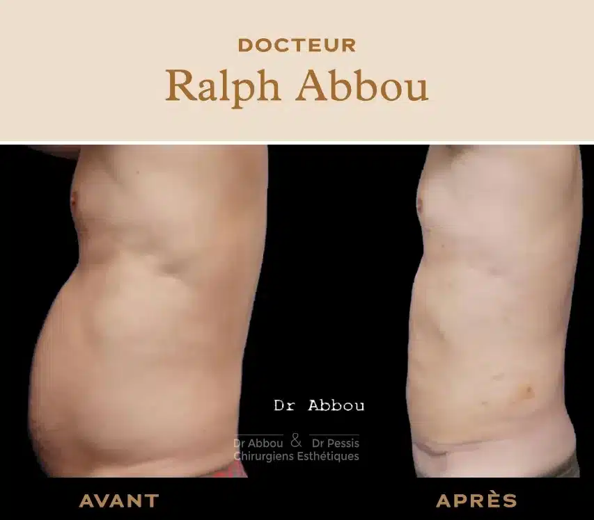 découvrez comment traiter la diastase abdominale efficacement pour retrouver un ventre plat rapidement grâce à des exercices ciblés et conseils professionnels.